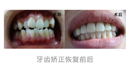 關(guān)于隱形正畸的相關(guān)知識你知道多少