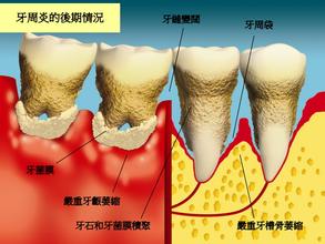 牙周病應(yīng)該怎樣正確護(hù)理？