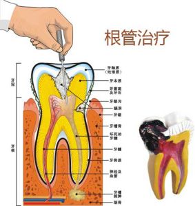 根管治療機(jī)擴(kuò)的優(yōu)點(diǎn)
