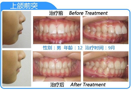 牙齒前凸怎么辦
