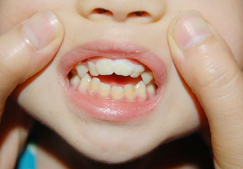 幼兒口腔護(hù)理的方法還有哪些呢