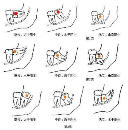 長智齒了怎么辦