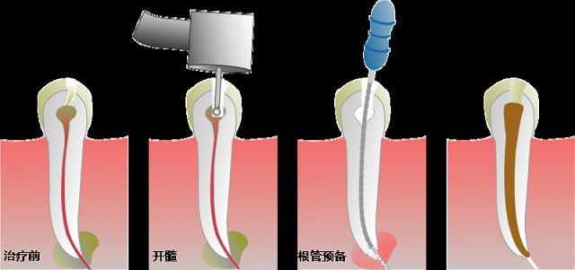 根管治療