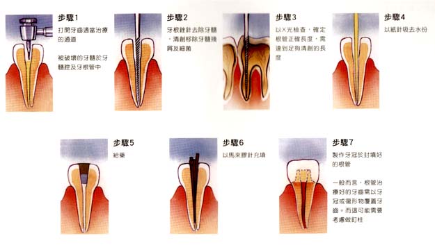 漳州根管治療有哪些注意事項