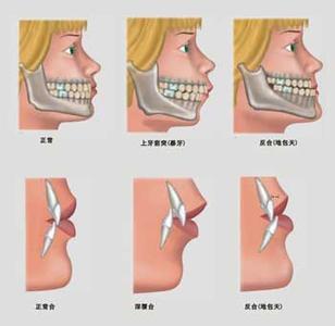 漳州齙牙有哪些危害